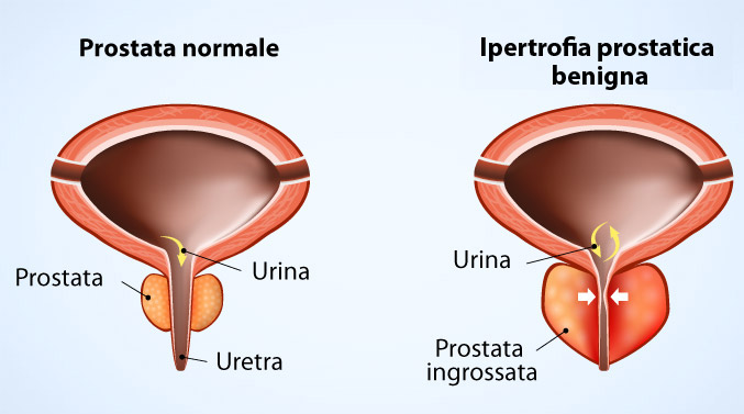 prostata ingrossata dopo intervento